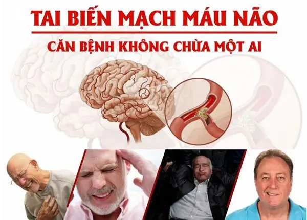 Đột quỵ thường đến sau… một cơn đau đầu bị xem nhẹ!