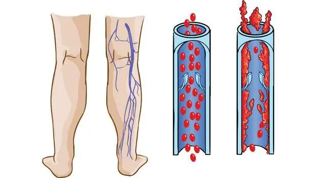 Tắc mạch chi ở bệnh nhân nằm lâu: Biến chứng nguy hiểm có thể đe dọa tính mạng