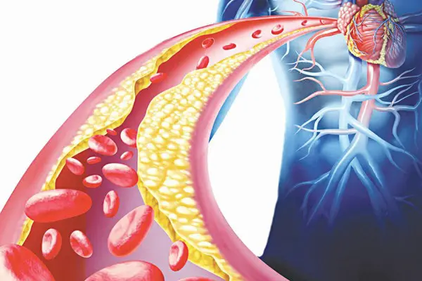 Mỡ máu cao: Căn bệnh của người thành đạt… nhưng mất tất cả