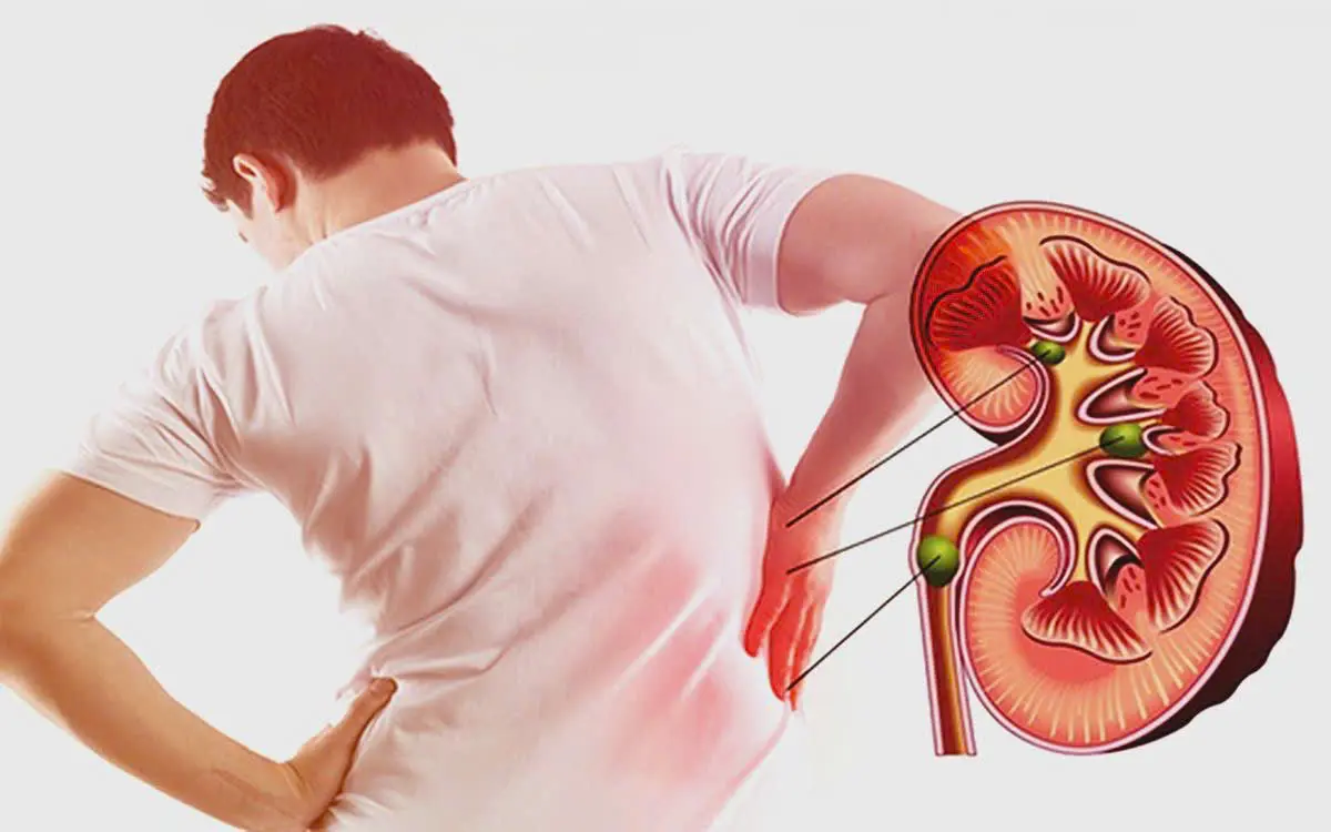 Vì sao sỏi thận hình thành? Hiểu đúng để phòng tránh từ sớm