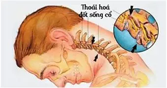 Thoái hóa đốt sống cổ đang dần trẻ hóa: Đừng để cơn đau cổ trở thành nỗi ám ảnh tuổi trẻ