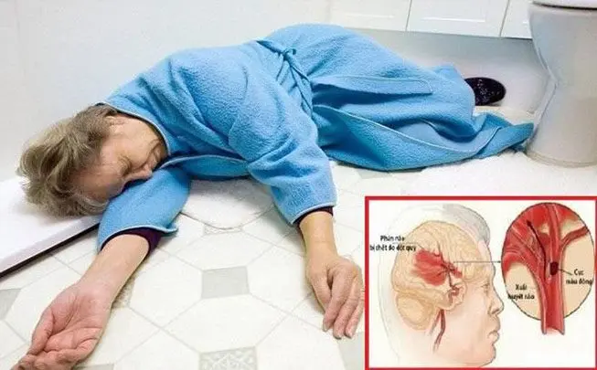 Cú Ngã Bất Ngờ Trong Phòng Tắm” – Hồi Chuông Cảnh Báo Của Đột Quỵ Thầm Lặng