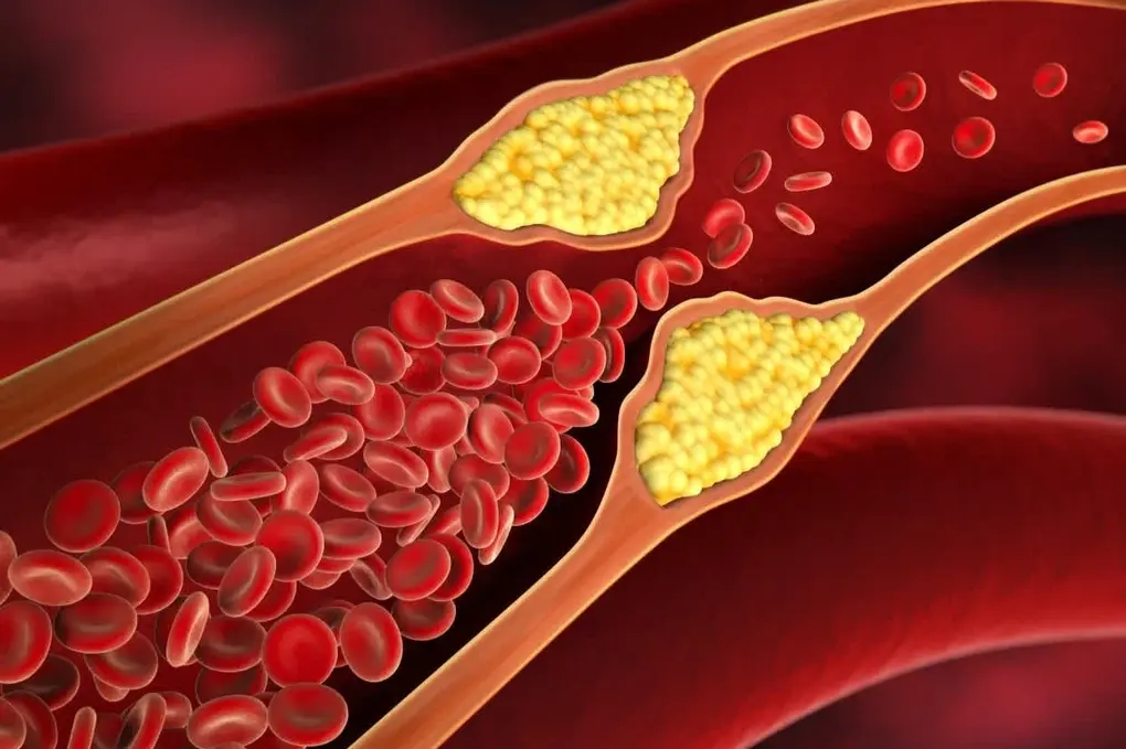 Không đau, không sốt, không mệt — nhưng mỡ máu đang âm thầm tàn phá cơ thể mỗi ngày!