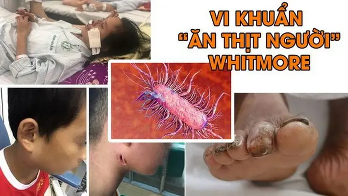 Cứu sống trẻ mắc bệnh Whitmore nguy hiểm