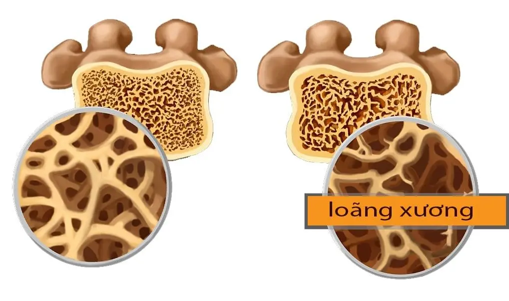 Loãng xương sau đột quỵ: Biến chứng âm thầm khiến nguy cơ gãy xương tăng cao