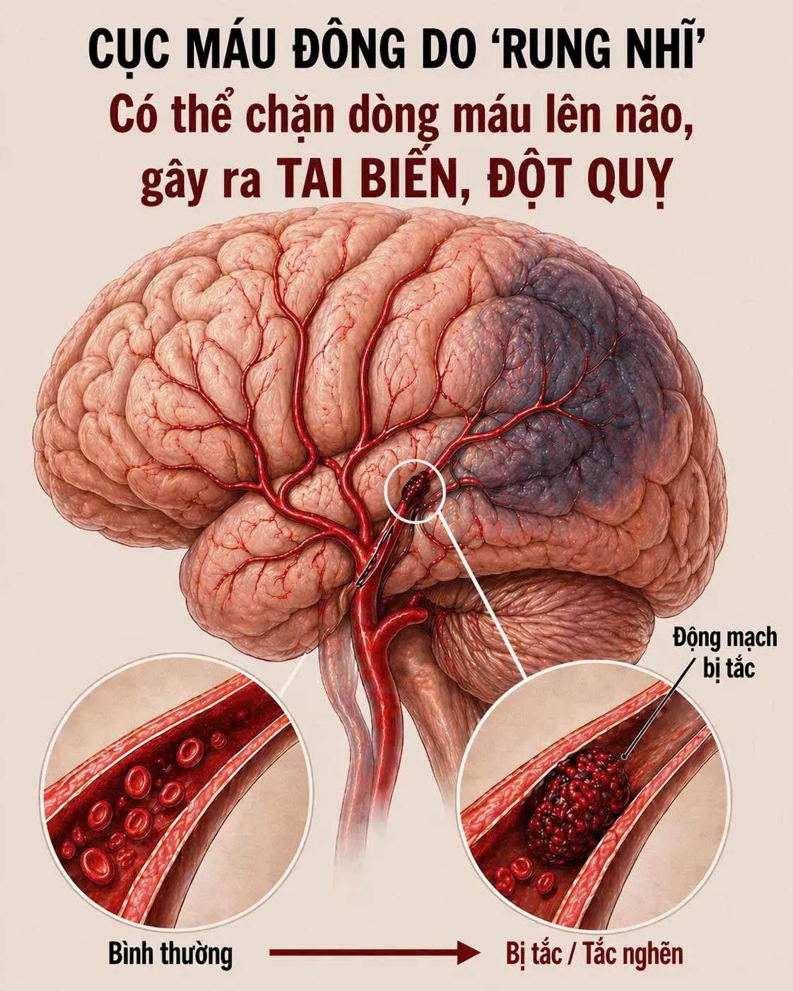KHI TRÁI TIM "LỖI NHỊP" VÀ BẢN ÁN TỬ HÌNH TREO TRÊN ĐẦU NÃO BỘ